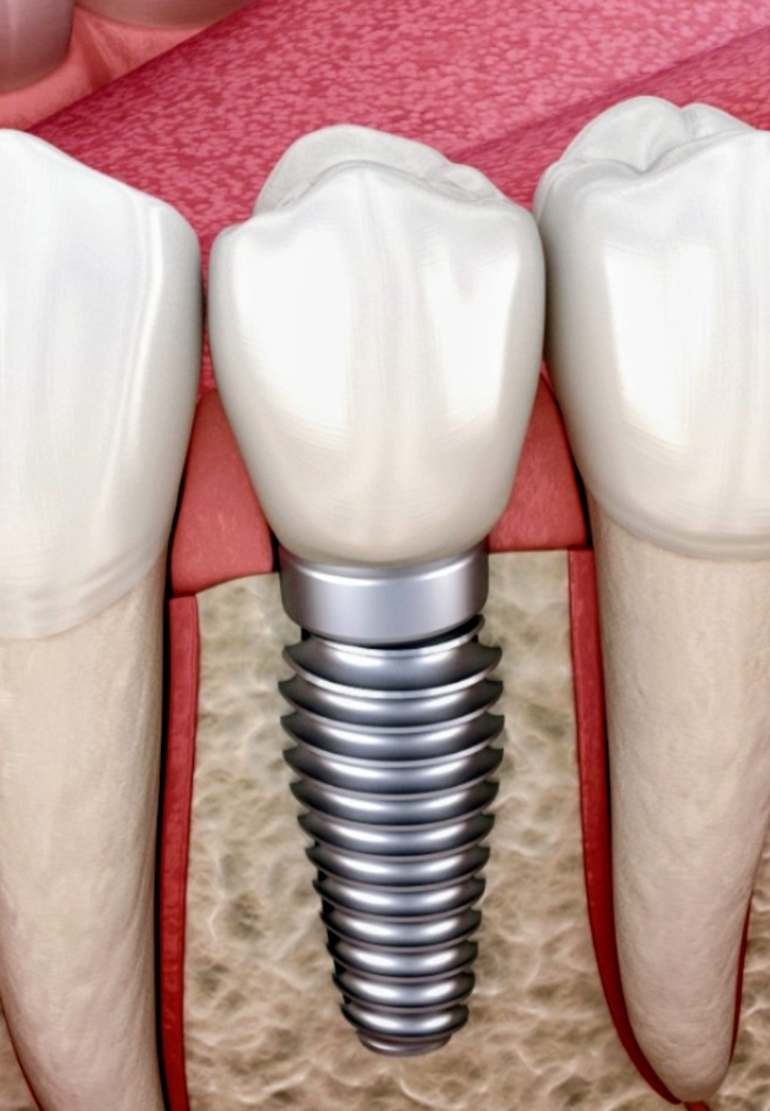 Implantes individuais 