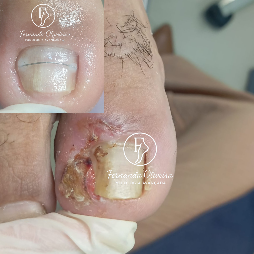 Plano de tratamento+corre&ccedil;&atilde;o fio de a&ccedil;o.